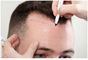 Best Hair Transplant in Udaipur